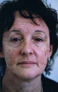 erbium_laser_full_face_1_300.jpg