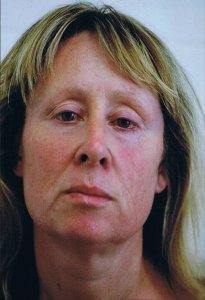 erbium_laser_resurfacing_after___front_view_300.jpg