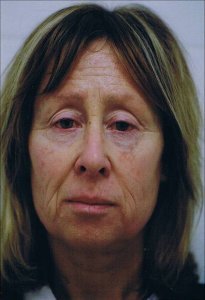 erbium_laser_resurfacing_before__front_view_300.jpg