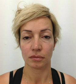 how to treat under eye hollows