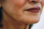 jowl_liposuction_after_100.jpg