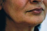 jowl_liposuction_before_100.jpg