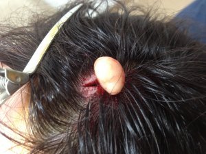 Bumps Under the Skin on My Scalp | LIVESTRONG.COM