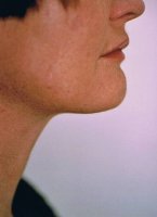lipodissolve_lipolysis_neck_after_200.jpg