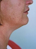 lipodissolve_lipolysis_neck_before_200.jpg