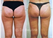 liposuctionm150_1.jpg