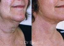 neck_lift_1.jpg
