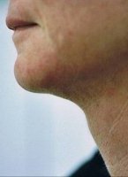 neck_liposuction_side_view_after_200.jpg