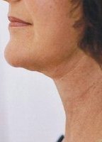 neck_liposuction_thread_lift_side_view_after_200.jpg