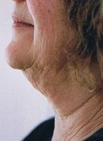 neck_liposuction_thread_lift_side_view_before_200.jpg