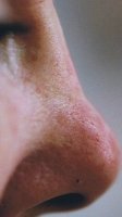 nonsurgical_liquid_nose_job_200__before.jpg