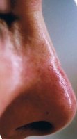 nonsurgical_liquid_nose_job_200_after.jpg