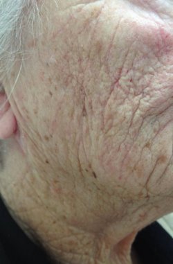 restylane dermal filler cheek after 250 restylane dermal filler cheek after 250
