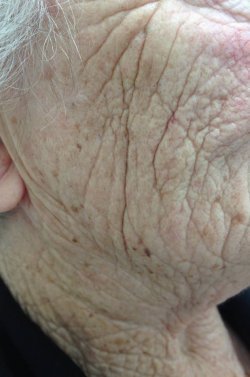 restylane dermal filler cheek before 250 restylane dermal filler cheek before 250