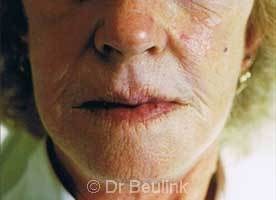 restylane_dermal_filler_face_1_1_1.jpg