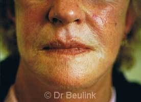 restylane_dermal_filler_face_2_1.jpg