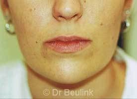 restylane_dermal_filler_lips_1_1.jpg