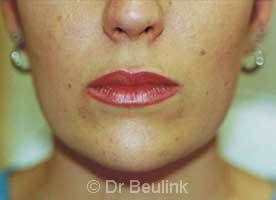 restylane_dermal_filler_lips_2_1.jpg