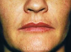 restylane_dermal_filler_lips_3_1.jpg