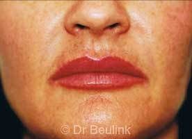 restylane_dermal_filler_lips_4_1.jpg