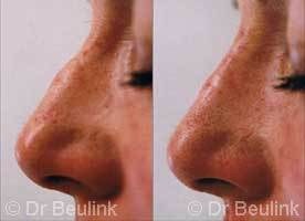 non surgical restylane_nose_job_1_1.jpg