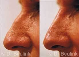 restylane_nose_job_2_1.jpg
