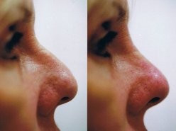 non surgical restylane_nose_reshaping.jpg