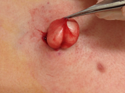 Facial cyst removal cut Amateur sex wrestling