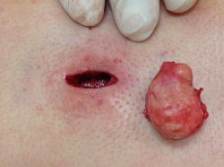 Facial cyst removal cut Bear gay man muscle