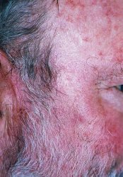sun_damage_after_photodynamic_therapy_1.jpg