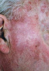 sun_damage_after_photodynamic_therapy_250.jpg
