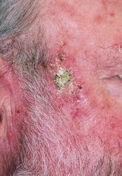 sun_damage_before_photodynamic_therapy_1_250.jpg