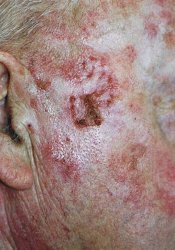 sun_damage_before_photodynamic_therapy_250.jpg