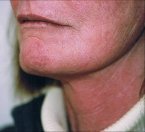 thread_lift_neck_sling_thread_after.jpg