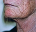 thread_lift_neck_thread_before.jpg