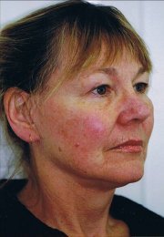 threadlift_face_side_view_resize_after.jpg