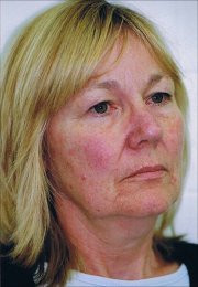 threadlift_face_side_view_resize_before.jpg